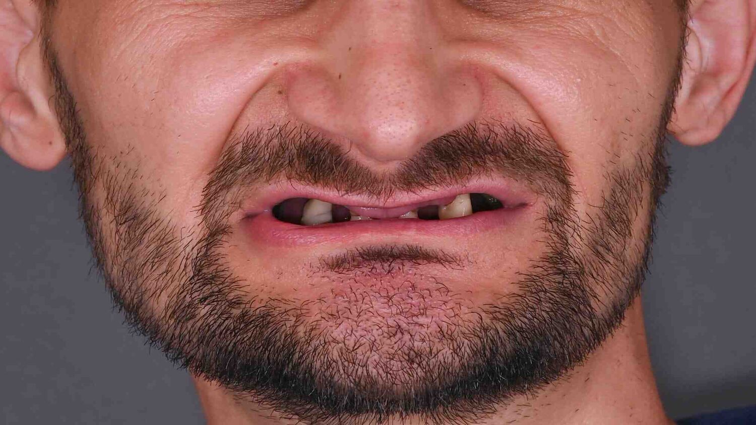 Pacient Clinica Dr. Alin Odor - Rezultat Implantologie